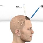 Mit modernen Verfahren können die Transplantationen heute durchgeführt werden. Bildquelle: ©