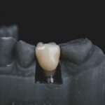 Implantate haben die Brücke oder gar die 3. Zähne zu einem Großteil abgelöst. Die Verarbeitung spielt jedoch eine große Rolle. Bildquelle: © Bogdan Condr / Unsplash.com