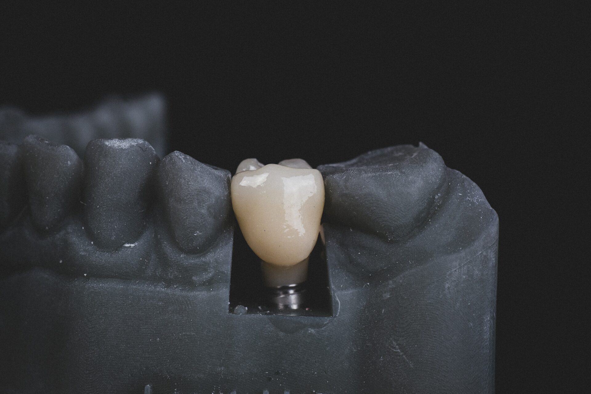 Zahnimplantate sind modernster Zahnersatz, aber auch entsprechend kostspielig. Bildquelle: © Jonathan Borba / Unsplash.com